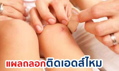 แผลถลอกติดเอดส์ไหม แผลแบบไหนที่ทำให้ติดเชื้อเอชไอวีได้